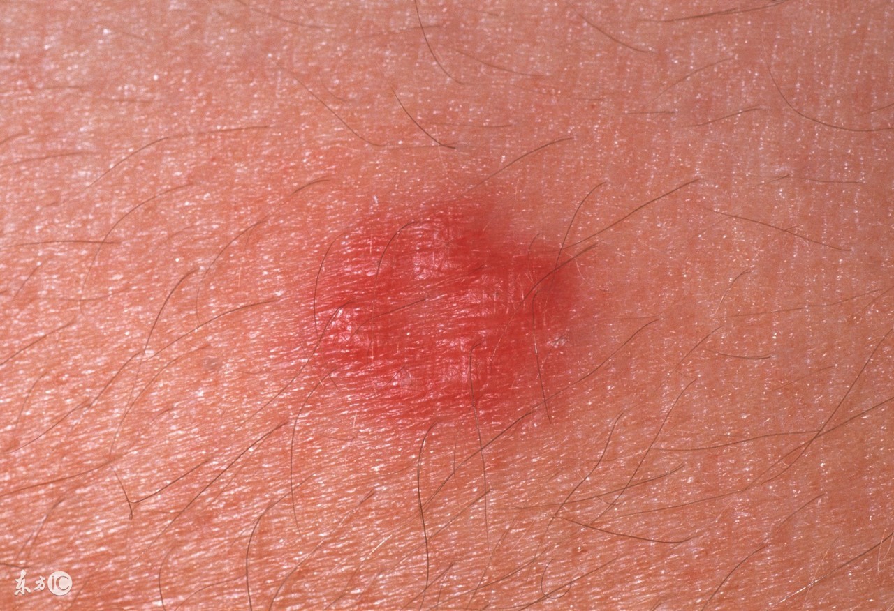 破伤风皮试怎么判断是阴还是阳,破伤风做皮试对身体有无影响