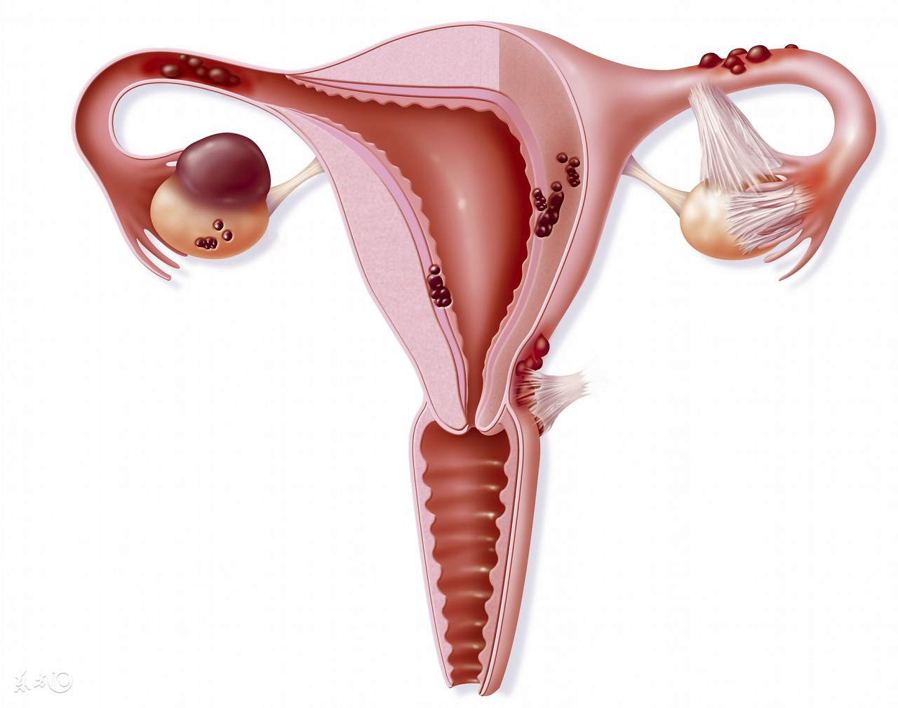 怎样预防母猪子宫内膜炎,猪产后怎么预防子宫内膜炎