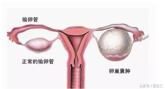 肚子隐隐疼是卵巢囊肿发作了吗,卵巢囊肿破裂出血怎么治疗