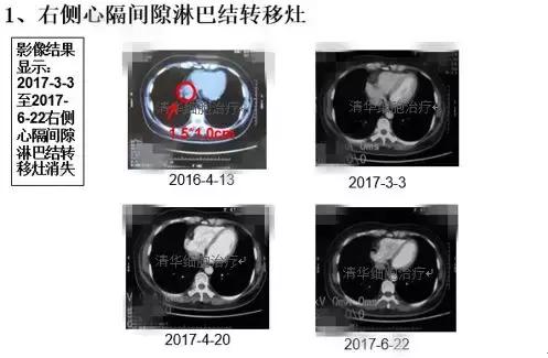 肺腺癌晚期nkt细胞免疫治疗价格,肺癌晚期nk细胞疗法