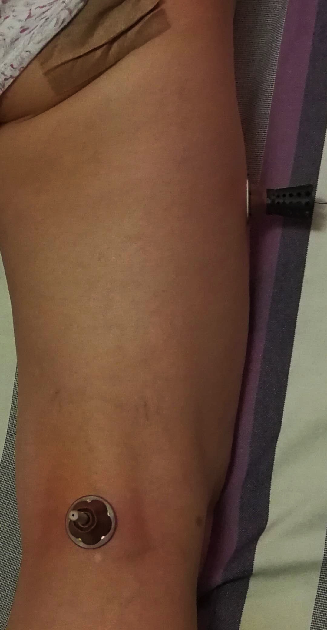 平衡疗法治疗腰腿疼,经方治疗椎间盘突出医案