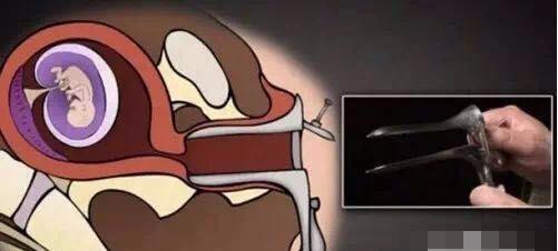 堕胎时人类是怎样一步步杀死自己孩子的?妈妈会看哭!