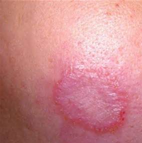 女孩被蚊子咬了两个包,女生被蚊子咬了个包