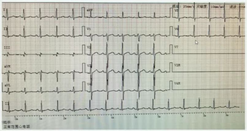 郑大一附院心血管内科专家陈英伟,房颤的治疗策略及进展