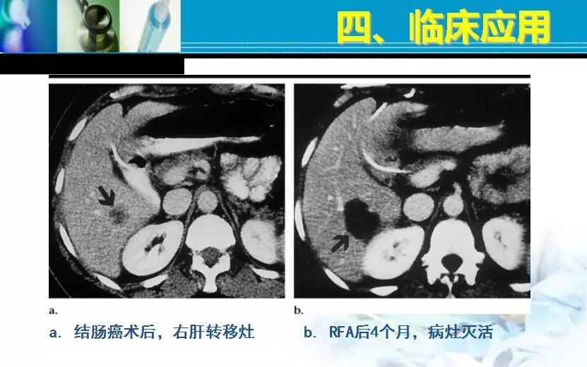 胆管肿瘤射频消融术,肿瘤射频消融厂家
