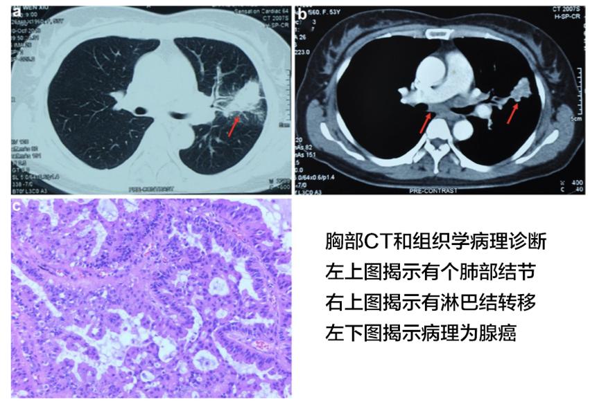 alk阳性肺癌耐药成功案例,肺癌alk阳性晚期能痊愈吗