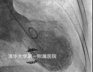 失恋过度心碎综合征,心碎综合症过度伤心真的会死吗