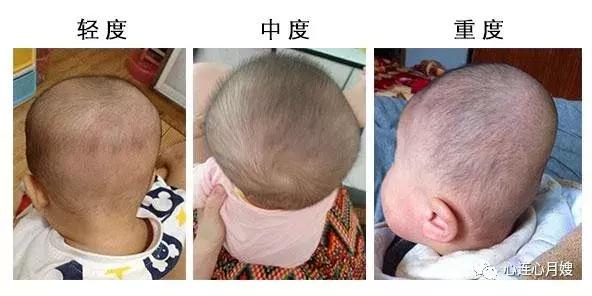 宝宝头睡偏了怎么补救,一岁宝宝头睡偏了怎么办