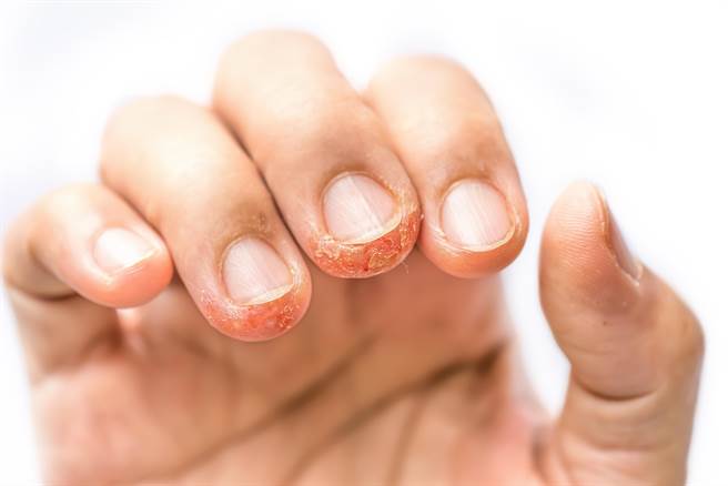 倒刺千万别乱撕严重可能被截肢,倒刺一直往下撕会怎么样