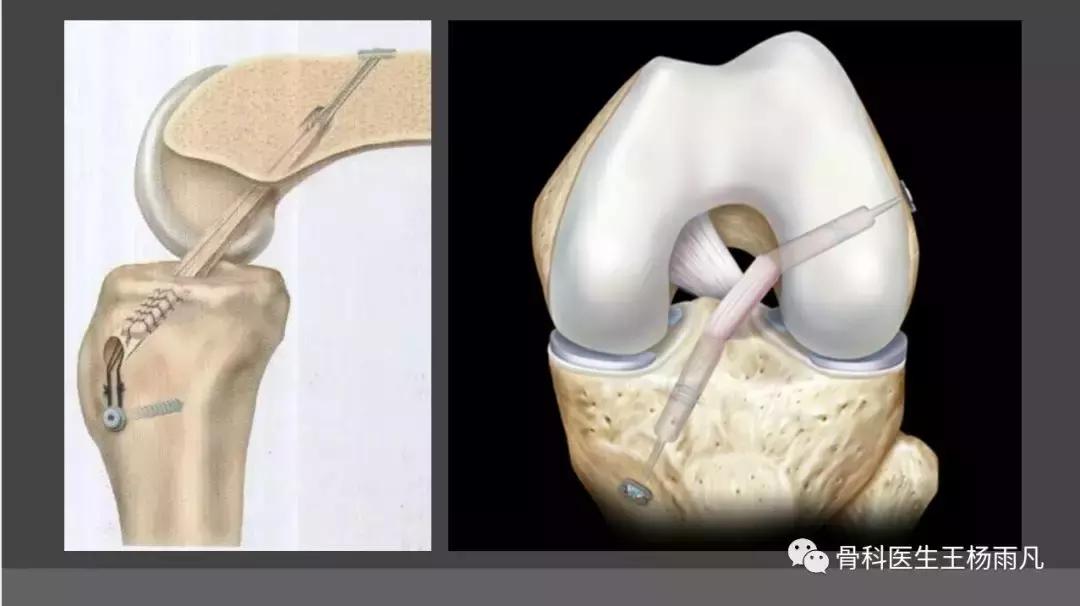 前叉重建人工韧带容易断裂吗,前叉十字韧带断裂怎么康复