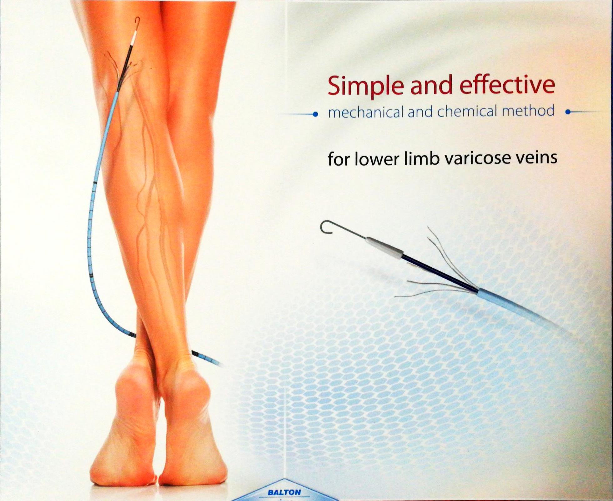 静脉曲张的微创治疗是怎么回事,治疗静脉曲张的新技术有哪些