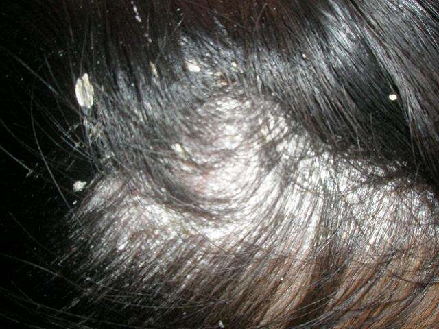 去除头皮屑的有效方法,用什么方法去头皮屑最有效