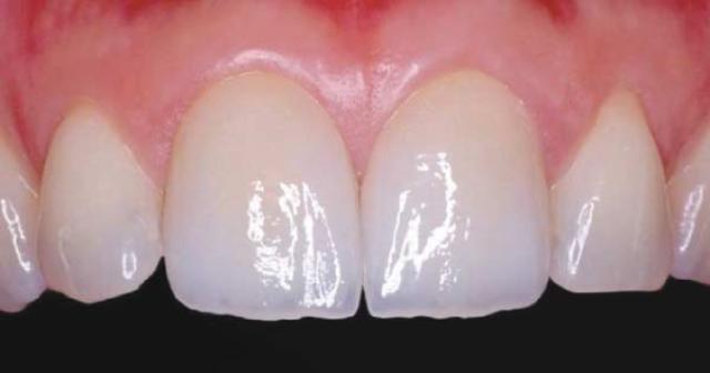 烤瓷牙修复一般要多久,烤瓷牙能彻底恢复牙齿吗