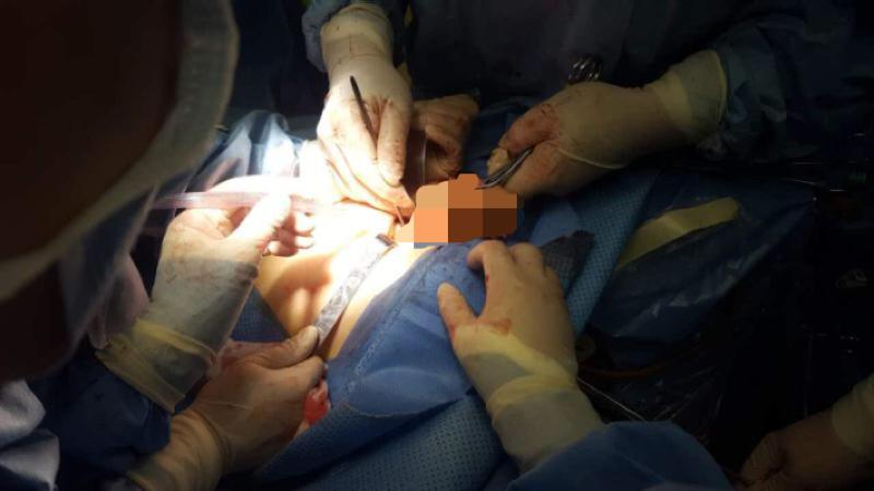 哈医大二院妇产科成功完成两孔腹腔镜下巨大子宫肌瘤切除手术