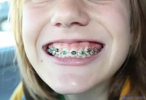 儿童矫正牙齿打骨钉的危害有哪些,一般情况下矫正牙齿效果有何差别