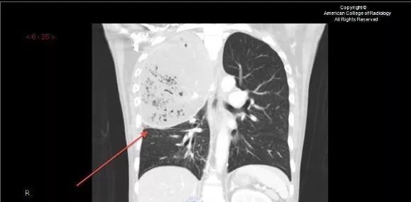 如何通过肺ct看出自己得了肺炎,肺ct怎么看出是病毒还是细菌