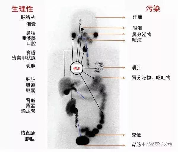 甲状腺癌进行碘治疗后有什么反应,甲状腺癌碘治疗后淋巴还有结节