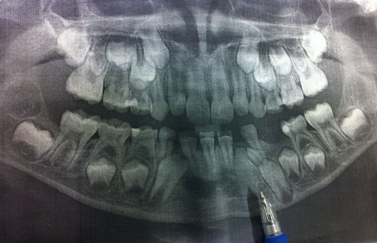 儿童长出多余的牙怎么处理,小孩上门牙有个窟窿怎么办