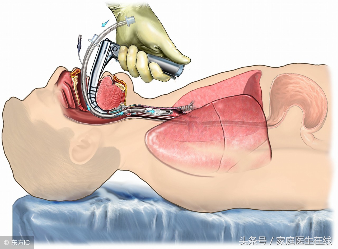 异物呛到气管里怎么办,异物呛进气管了怎么办