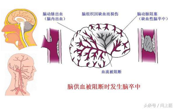 预防脑中风可以吃阿司匹林吗,吃他汀和阿司匹林能预防脑中风吗