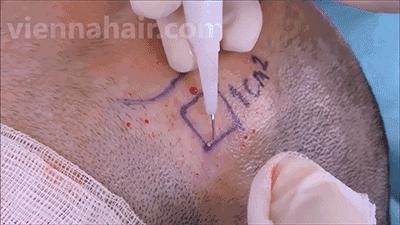 麦当劳薯条治疗脱发,麦当劳薯条掉头发