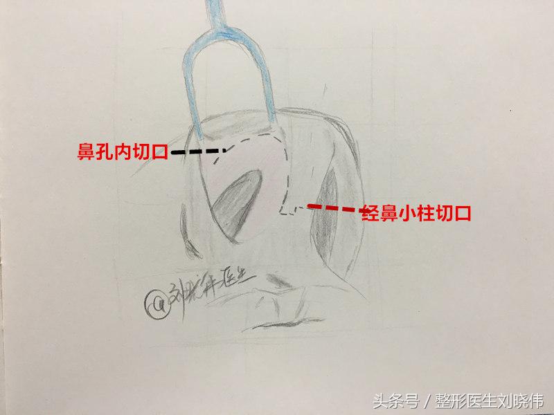 小鼻综合和大鼻综合的区别,鼻整形科普