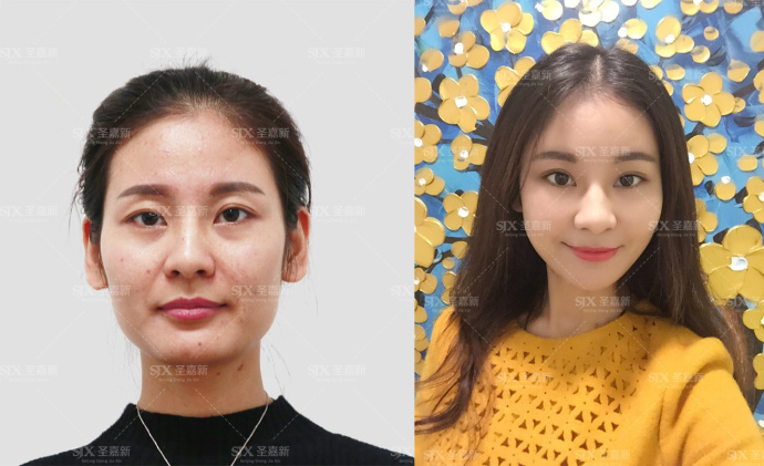 自体脂肪填充川字纹保持多久,自体脂肪填充10天内效果图