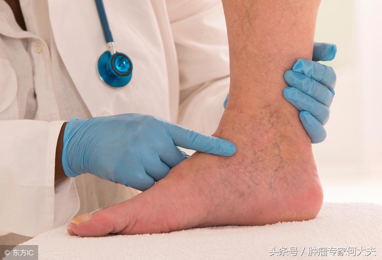 腿肿是癌症的表现么,腿肿居然是淋巴瘤引起的