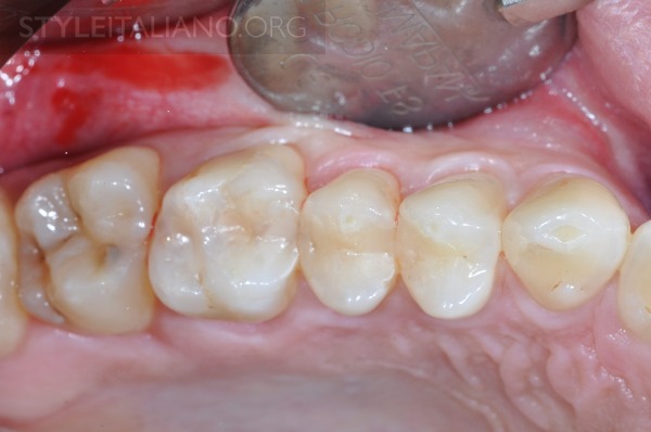 后牙修补贴片,后牙全瓷修复图片