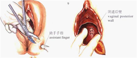 侧切其实没那么可怕,生孩子侧切伤口需要怎么护理