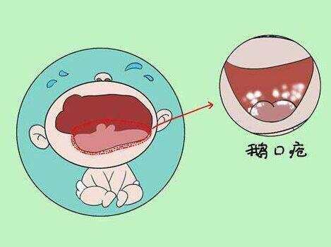 鹅口疮正确的擦拭方法,鹅口疮出血了要不要紧