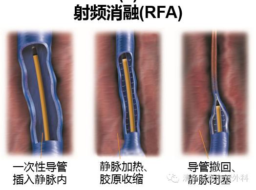 北京医院静脉曲张微创手术,清华长庚静脉曲张