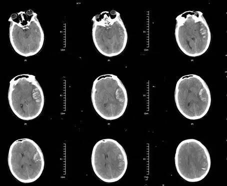 颅内静脉窦血栓ct特征,颅内静脉窦血栓的定性诊断