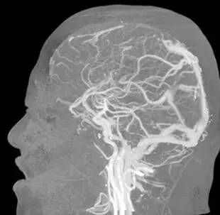 颅内静脉窦血栓ct特征,颅内静脉窦血栓的定性诊断