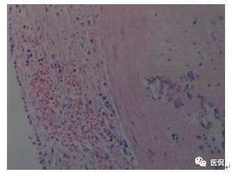 73岁患者因左鼻塞流脓涕4个月入院，CT发现一软组织高低混杂密度，怎么诊断？