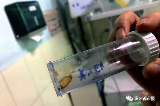 幼童吞下坚果泡椒笔盖……致咳嗽气喘，家长们以为是感冒