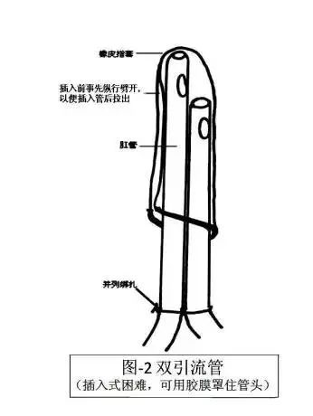 术后腹壁窦道怎样处理,腹部窦道手术怎么判断切除干净