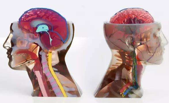 3D打印在脑出血治疗中的应用