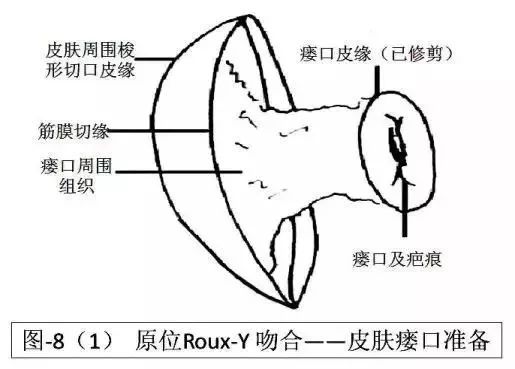 术后腹壁窦道怎样处理,腹部窦道手术怎么判断切除干净