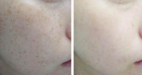 小苏打祛斑,纯天然面膜祛斑