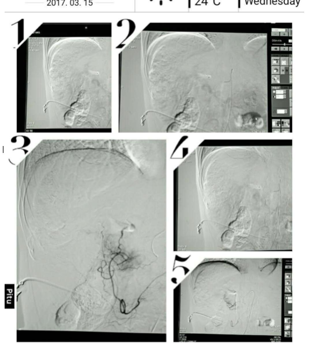 肝癌病例实例100例,肝癌的治疗方法论文