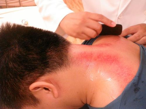 感冒喉咙痛刮痧刮哪个部位呢,感冒流清鼻涕刮痧刮哪里图解