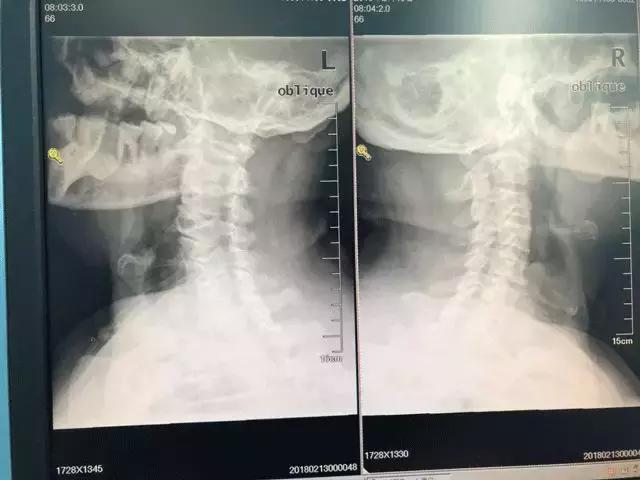 老人腰椎间盘突出需要微创手术吗,老人颈椎突出挺厉害能复位吗