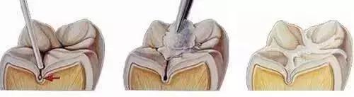 宝宝脸上小黑点怎么去掉,宝宝牙齿上的小黑点