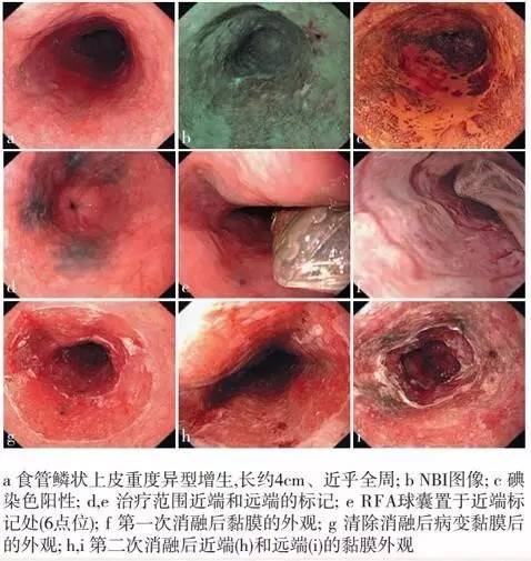 早期食管癌用内镜可以根除吗,超声内镜可以查出早期食管癌吗