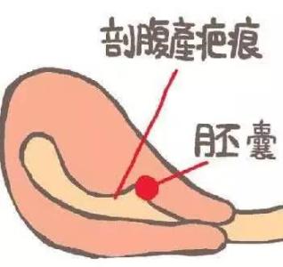 瘢痕子宫注意事项,瘢痕子宫厚2mm注意什么