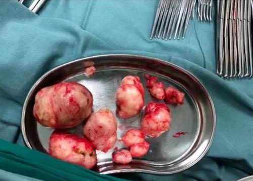 小肌瘤一定要全部剔除吗？