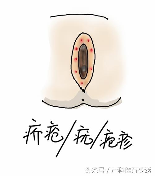 外阴瘙痒可以自愈吗,外阴瘙痒怎么治才会好啊