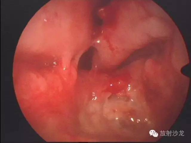 巨细胞性肉芽肿治疗费用,颌骨巨细胞修复性肉芽肿x线表现