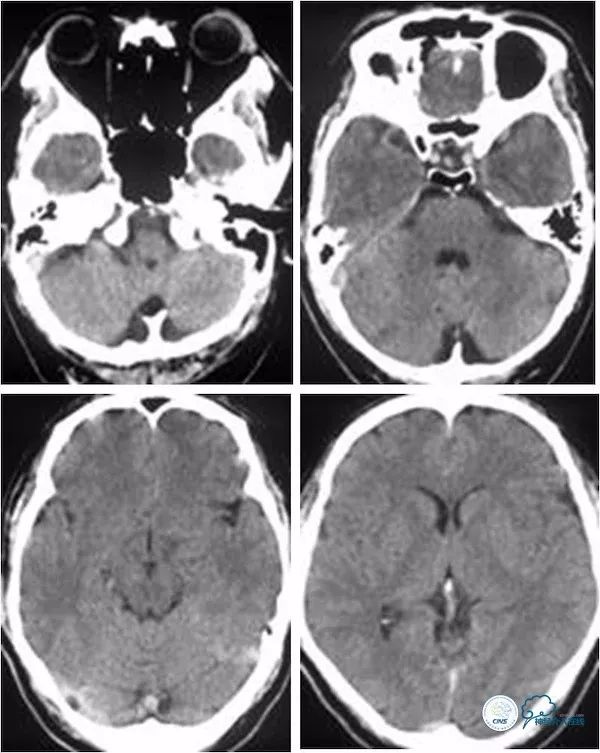 天坛医院做椎动脉狭窄多少要手术,天坛椎动脉狭窄